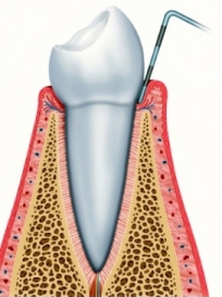 periodontal survey