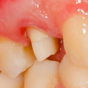 Genetic predisposition to periodontitis