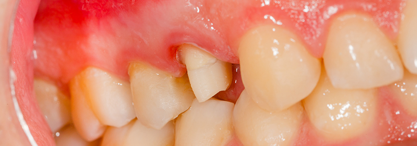 Genetic predisposition to periodontitis