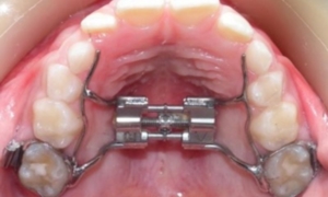 Milan palatal expander