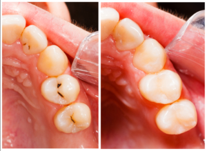 caries and peri-implantitis