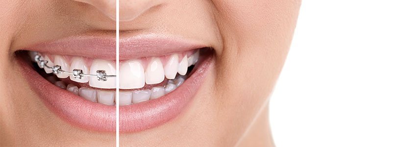 salute del parodonto e apparecchio dei denti