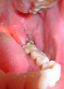 estrazione del dente del giudizio complicazioni