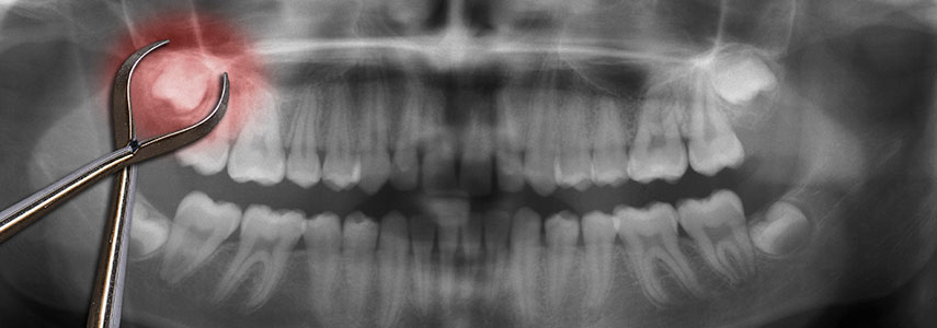estrazione del dente del giudizio dentista milano