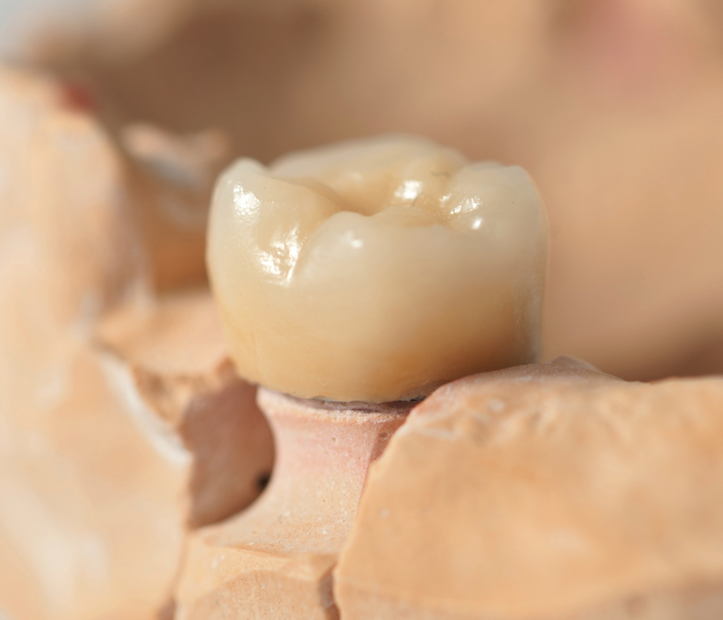 protesi in zirconia implantologia