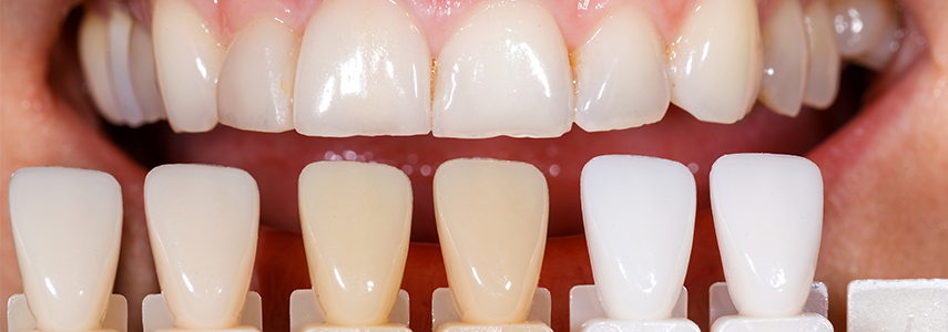 effectiveness of tooth whitening