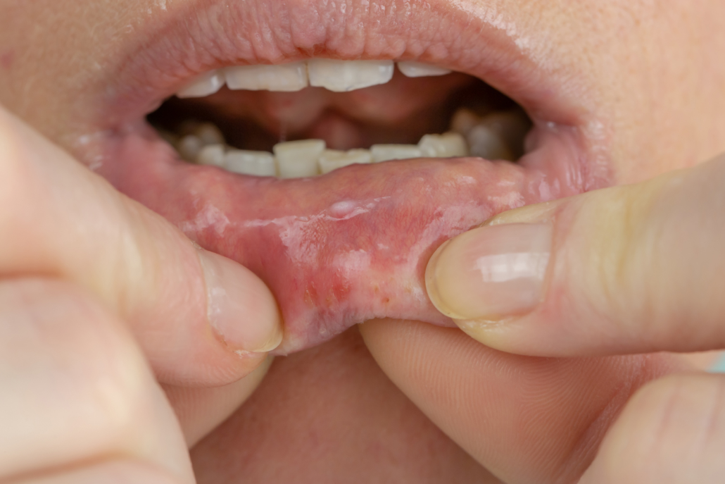 oral mucositis