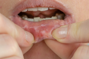 allergie ai materiali dentali