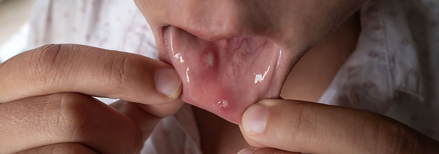 stomatite mucosite orale dentista milano