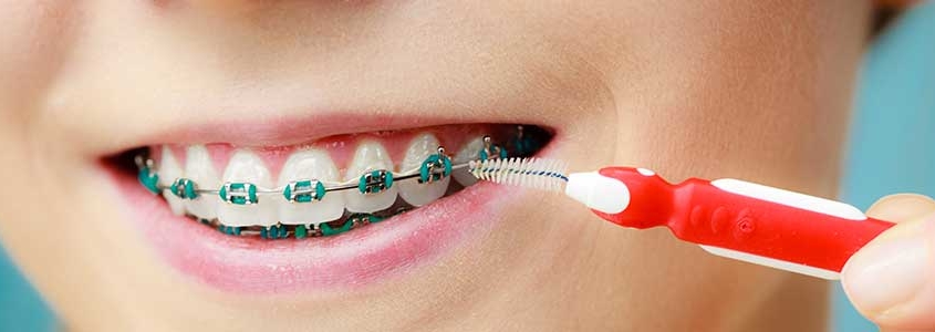 Gingival recessions after orthodontic treatment