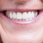 resistenza della zirconia protesi dentali