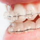 misalignment of the teeth orthodontics milan
