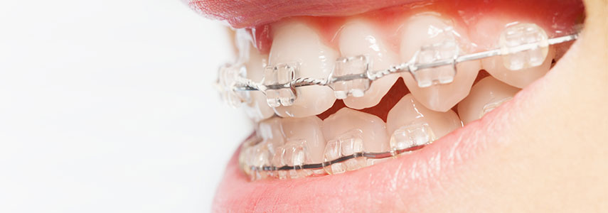 misalignment of the teeth orthodontics milan