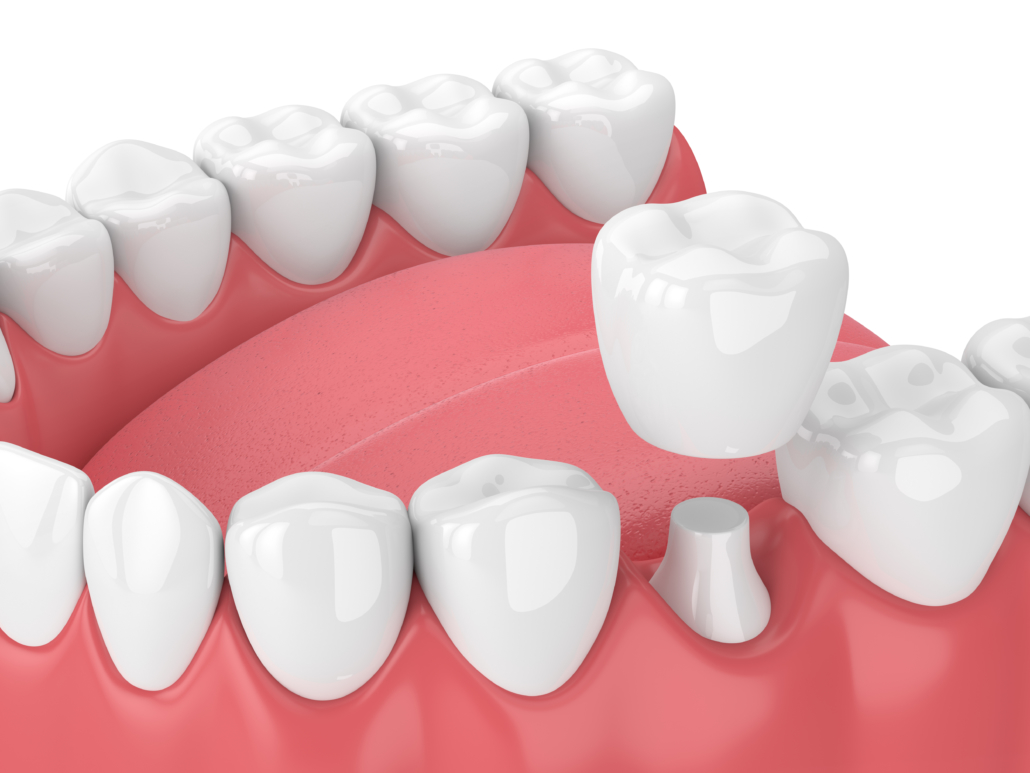 replacement dental capsules