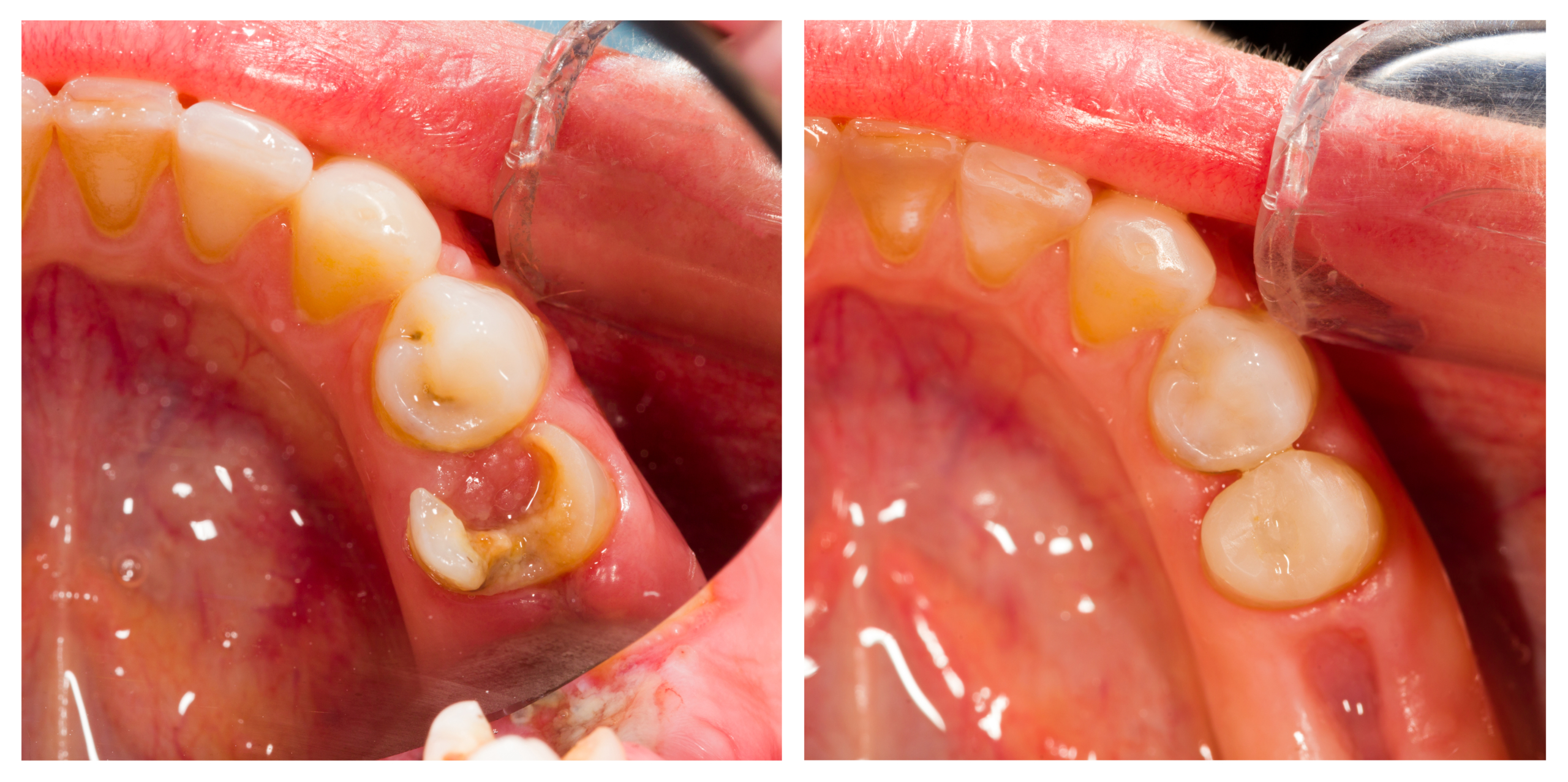 Direct pulp capping of the tooth in cases of pulpitis