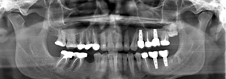 cura della perimplantite dentista milano