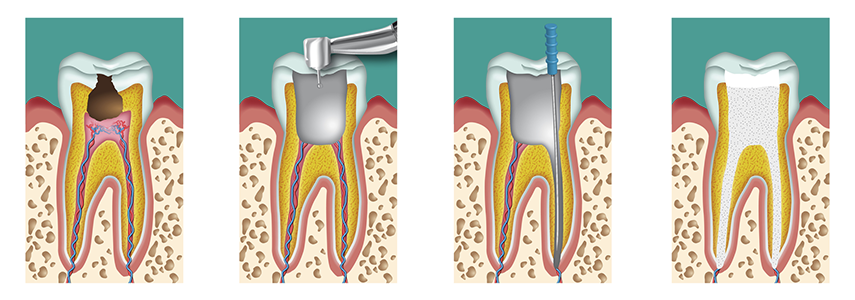 failure of root canal treatment dentist milan