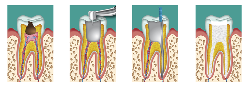 fallimento della cura canalare dentista milano