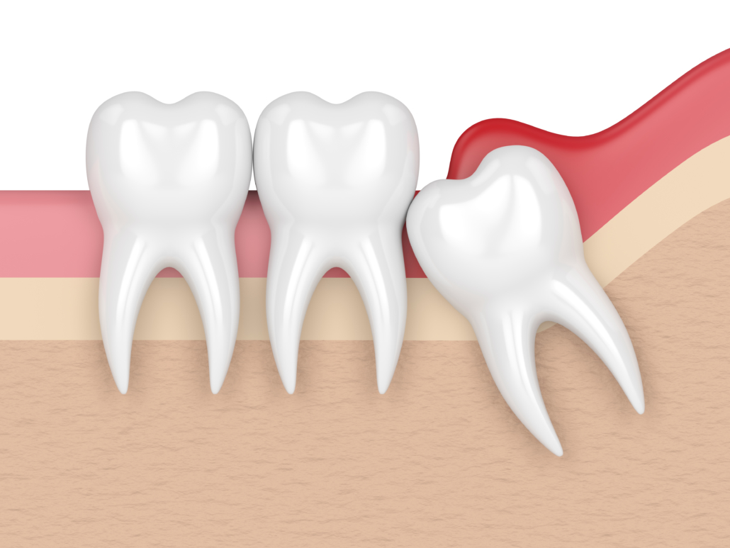 inflammation of the gum pericoronitis