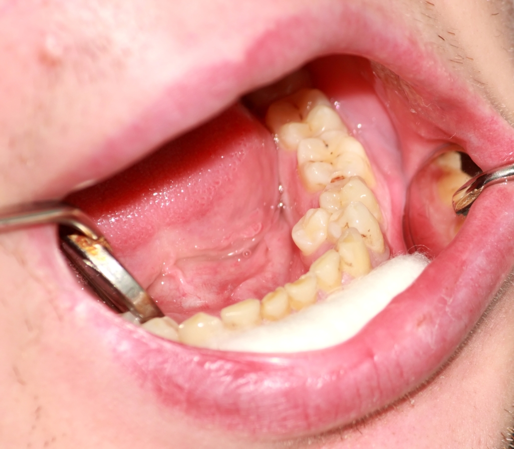 dental caries fluoride varnish