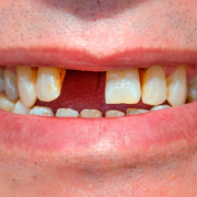 sostituire i denti caduti milano