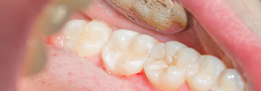 signs of amalgam and metal