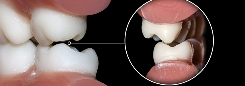 nocturnal bruxism in children