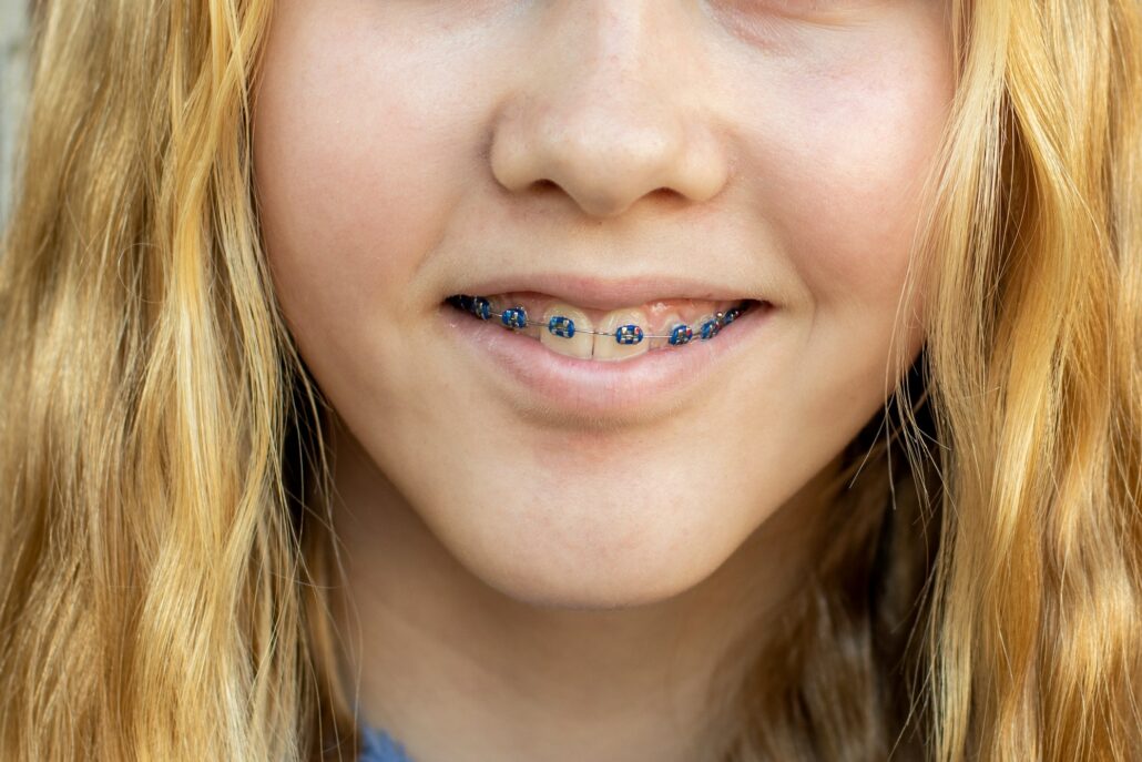 Teenage girl wearing metal braces. Orthodontic dental braces teeth straighteners